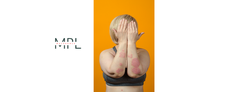 PSORIASIS: WHAT IS IT AND WHAT CAN YOU DO ABOUT IT?